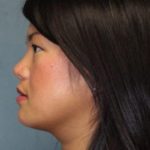 Rhinoplasty Before & After Patient #3898