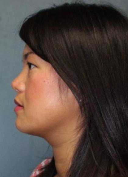 Rhinoplasty Before & After Patient #3898
