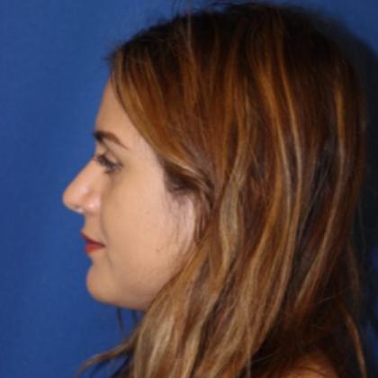 Rhinoplasty Before & After Patient #3993