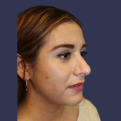 Rhinoplasty Before & After Patient #3993