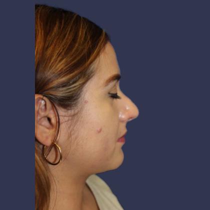 Rhinoplasty Before & After Patient #3993