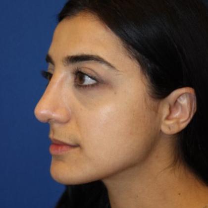 Rhinoplasty Before & After Patient #4018