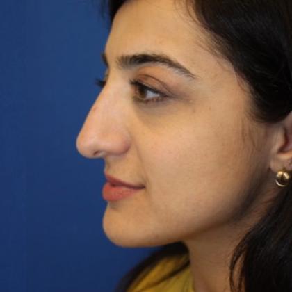 Rhinoplasty Before & After Patient #4018