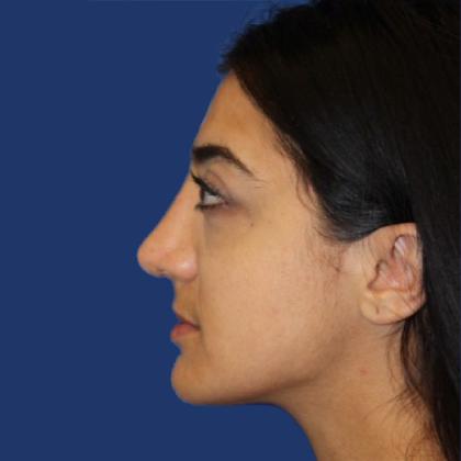 Rhinoplasty Before & After Patient #4018