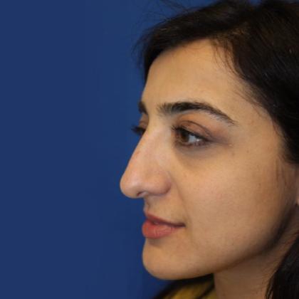 Rhinoplasty Before & After Patient #4018