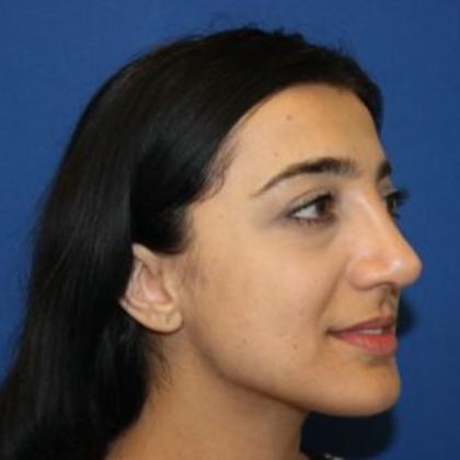 Rhinoplasty Before & After Patient #4018