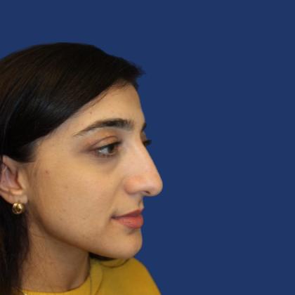 Rhinoplasty Before & After Patient #4018