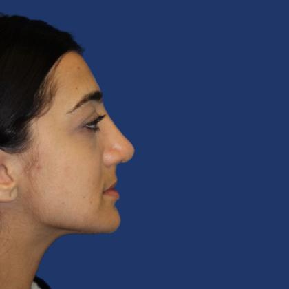 Rhinoplasty Before & After Patient #4018