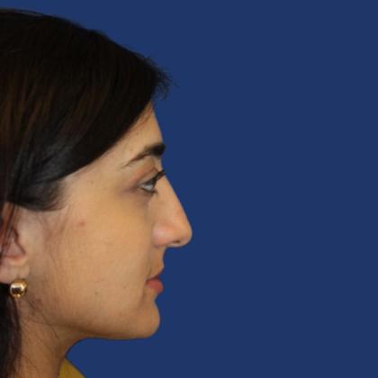 Rhinoplasty Before & After Patient #4018