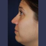 Rhinoplasty Before & After Patient #4030