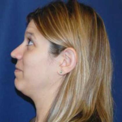 Rhinoplasty Before & After Patient #4030
