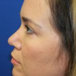 Rhinoplasty Before & After Patient #4099