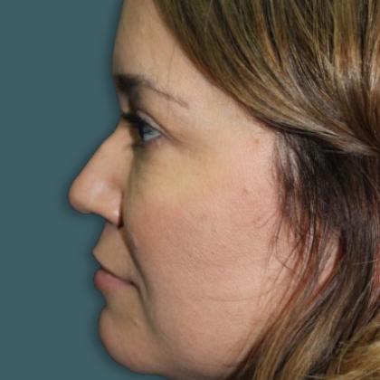 Rhinoplasty Before & After Patient #4099
