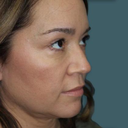 Rhinoplasty Before & After Patient #4099