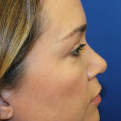 Rhinoplasty Before & After Patient #4099