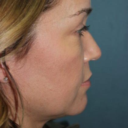 Rhinoplasty Before & After Patient #4099