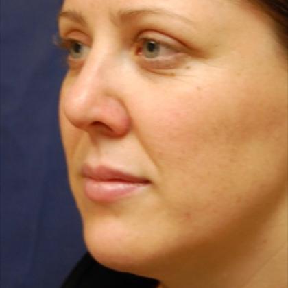 Rhinoplasty Before & After Patient #4136