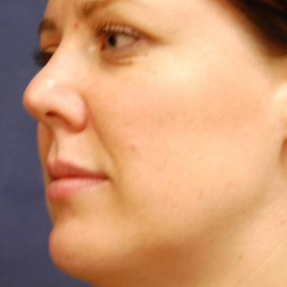 Rhinoplasty Before & After Patient #4136