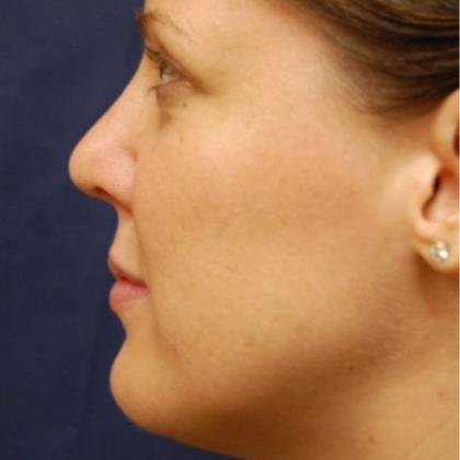 Rhinoplasty Before & After Patient #4136