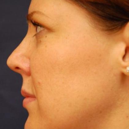 Rhinoplasty Before & After Patient #4136