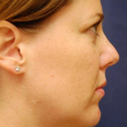 Rhinoplasty Before & After Patient #4136