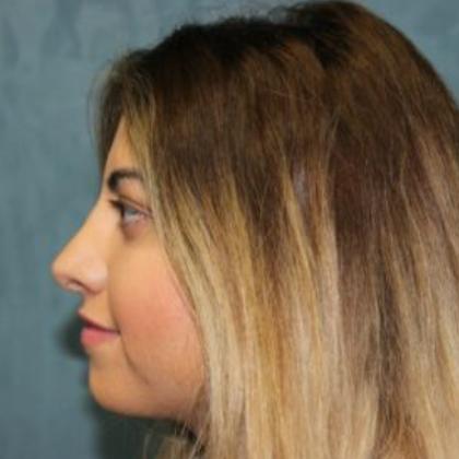 Rhinoplasty Before & After Patient #4250