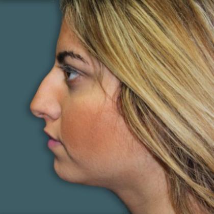 Rhinoplasty Before & After Patient #4250