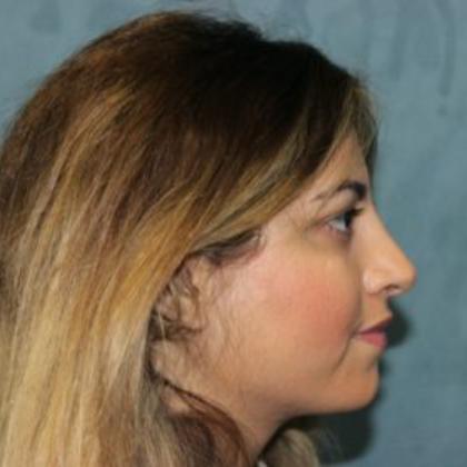 Rhinoplasty Before & After Patient #4250