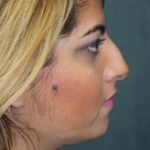 Rhinoplasty Before & After Patient #4250