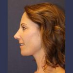 Rhinoplasty Before & After Patient #4270