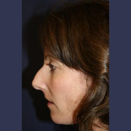 Rhinoplasty Before & After Patient #4270
