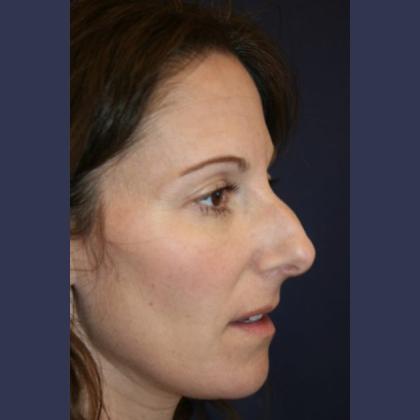 Rhinoplasty Before & After Patient #4270