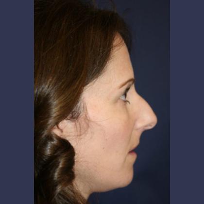 Rhinoplasty Before & After Patient #4270