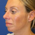 Rhinoplasty Before & After Patient #3669