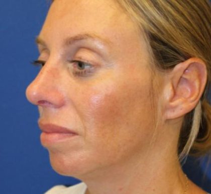 Rhinoplasty Before & After Patient #3669