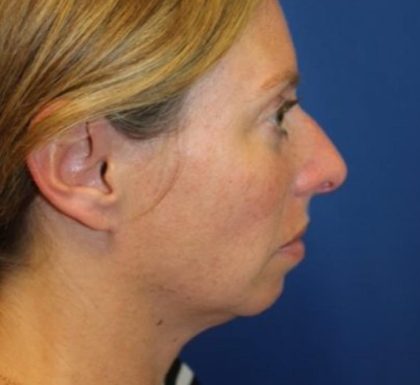 Rhinoplasty Before & After Patient #3669