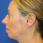 Rhinoplasty Before & After Patient #3669