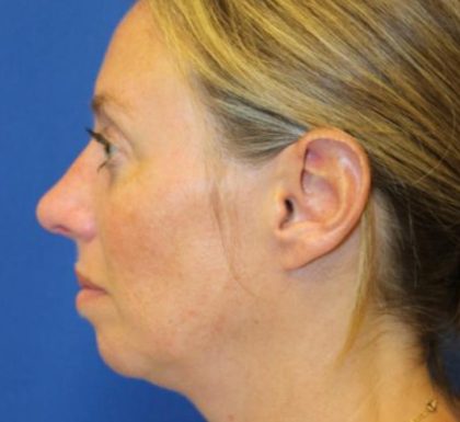 Rhinoplasty Before & After Patient #3669
