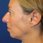Rhinoplasty Before & After Patient #3669