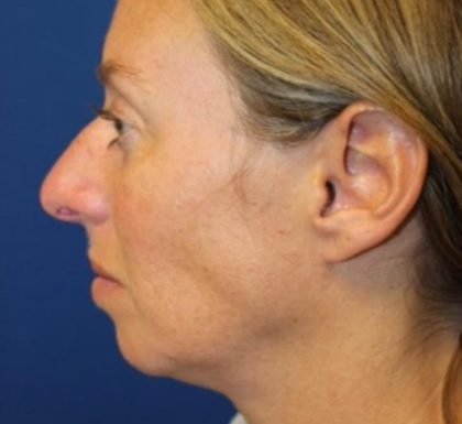 Rhinoplasty Before & After Patient #3669