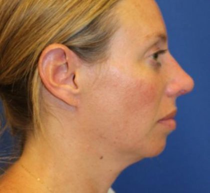 Rhinoplasty Before & After Patient #3669