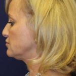 Rhinoplasty Before & After Patient #3724