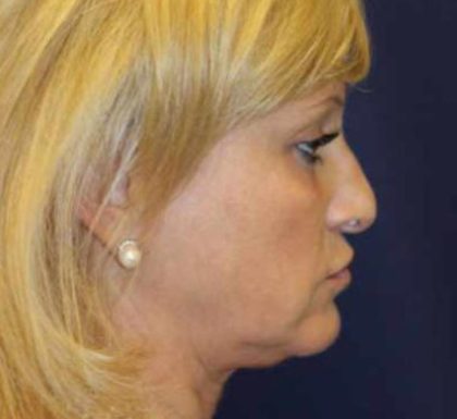 Rhinoplasty Before & After Patient #3724
