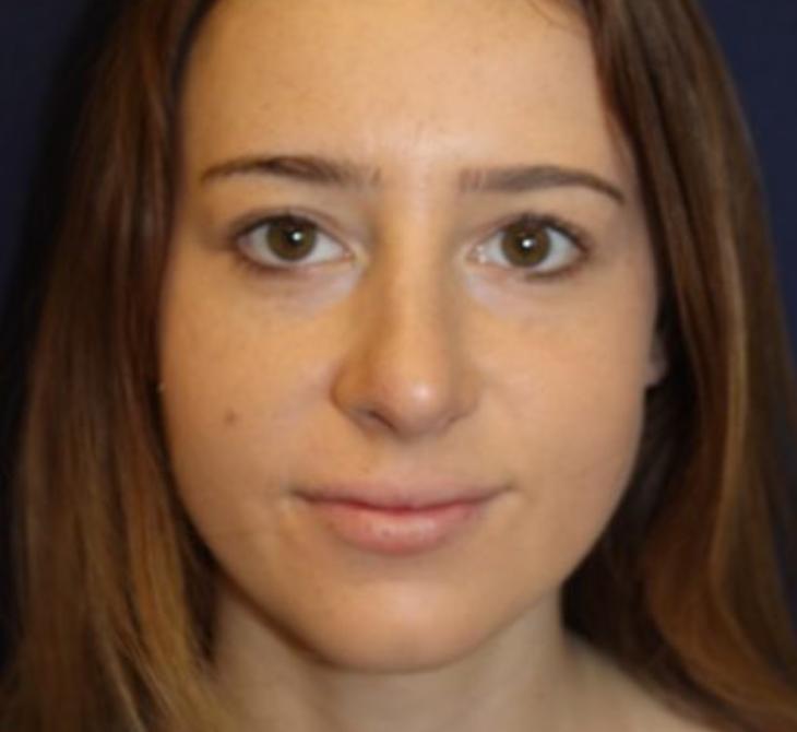 Rhinoplasty Before & After Patient #3735