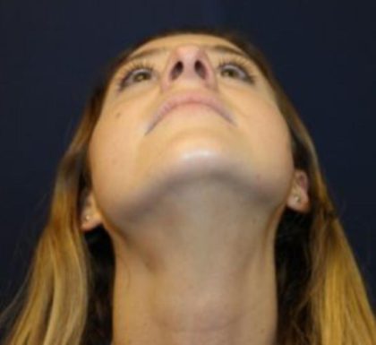 Rhinoplasty Before & After Patient #3735