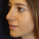 Rhinoplasty Before & After Patient #3735