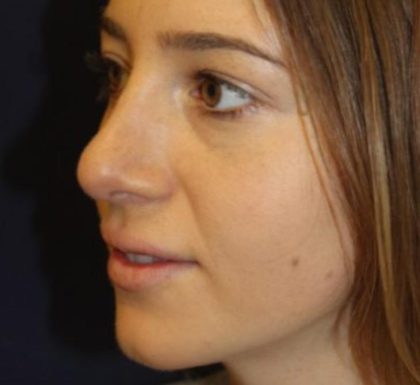 Rhinoplasty Before & After Patient #3735