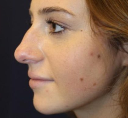 Rhinoplasty Before & After Patient #3735