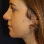 Rhinoplasty Before & After Patient #3735