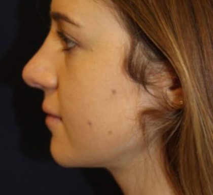 Rhinoplasty Before & After Patient #3735